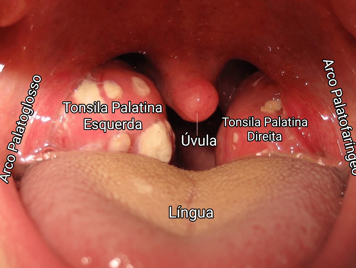 O Que São Essas Protuberâncias Brancas na Sua Boca e Elas Podem Estar Relacionadas a Hábitos Diários Comuns