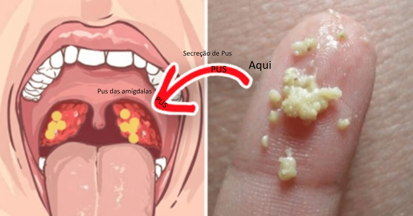 O Que São Essas Protuberâncias Brancas na Sua Boca e Elas Podem Estar Relacionadas a Hábitos Diários Comuns