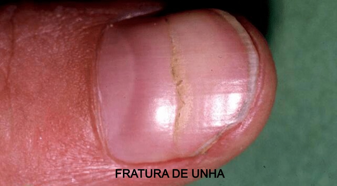 O Que Essas Estrias nas Unhas Realmente Significam? Hábitos Diários Simples para Ajudar a Manter as Unhas Mais Saudáveis