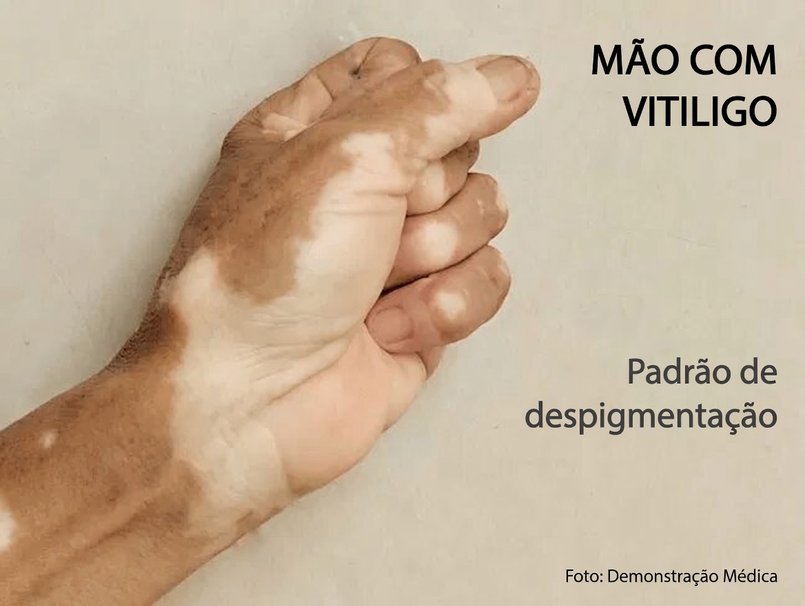 Por que aparecem manchas brancas nos seus braços e pernas? Entenda as causas comuns e as dicas de cuidados com a pele