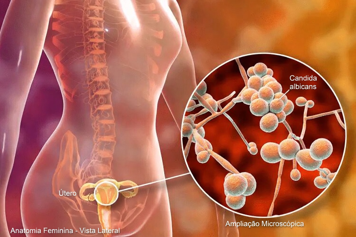Quais são os sinais comuns de uma infecção vaginal por fungos que toda mulher deveria conhecer?
