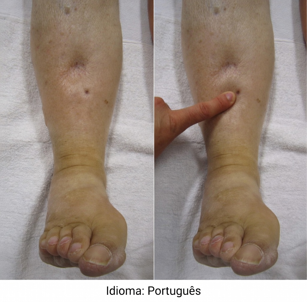 Quais são os 12 efeitos colaterais mais comuns da amlodipina e os hábitos diários que podem fazer a diferença?