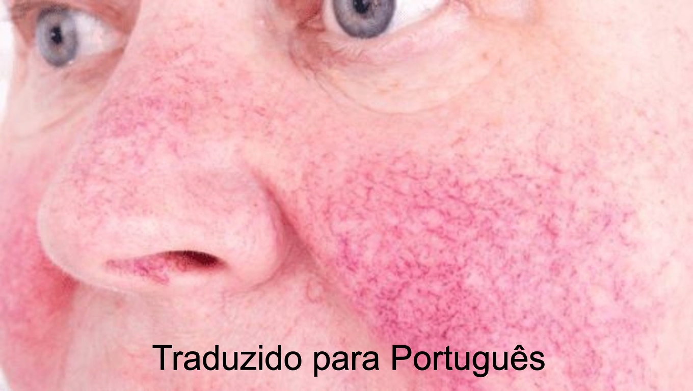 Quais são os 12 efeitos colaterais mais comuns da amlodipina e os hábitos diários que podem fazer a diferença?