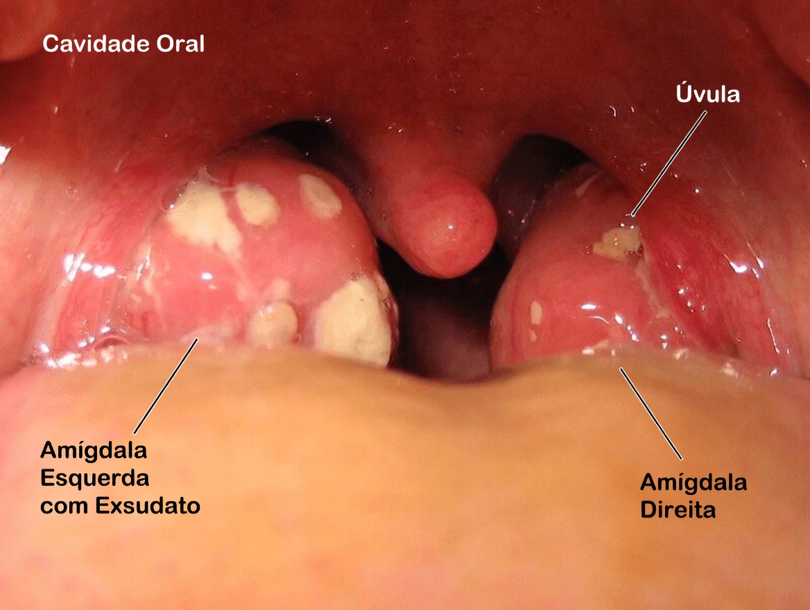 O que são essas protuberâncias brancas na sua boca e elas poderiam estar relacionadas a hábitos diários comuns