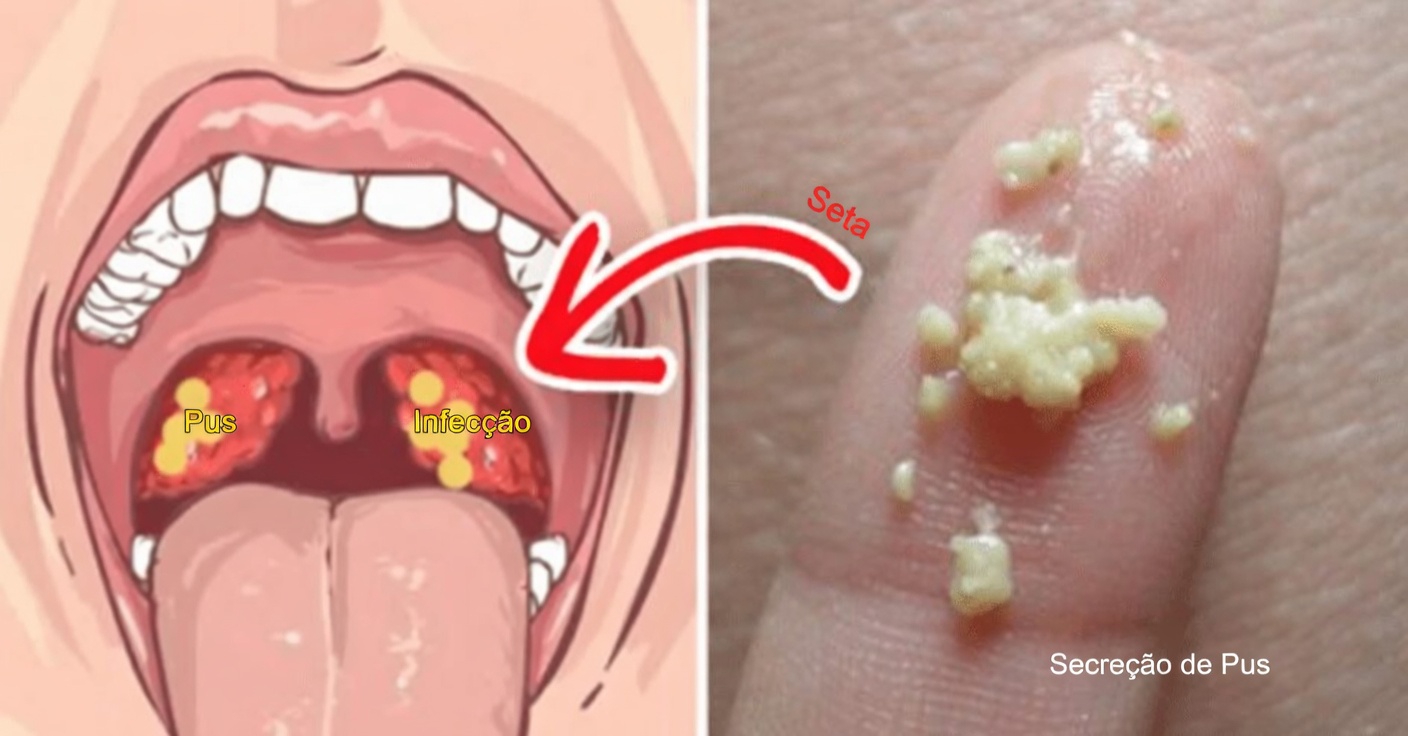 O que são essas protuberâncias brancas na sua boca e elas poderiam estar relacionadas a hábitos diários comuns