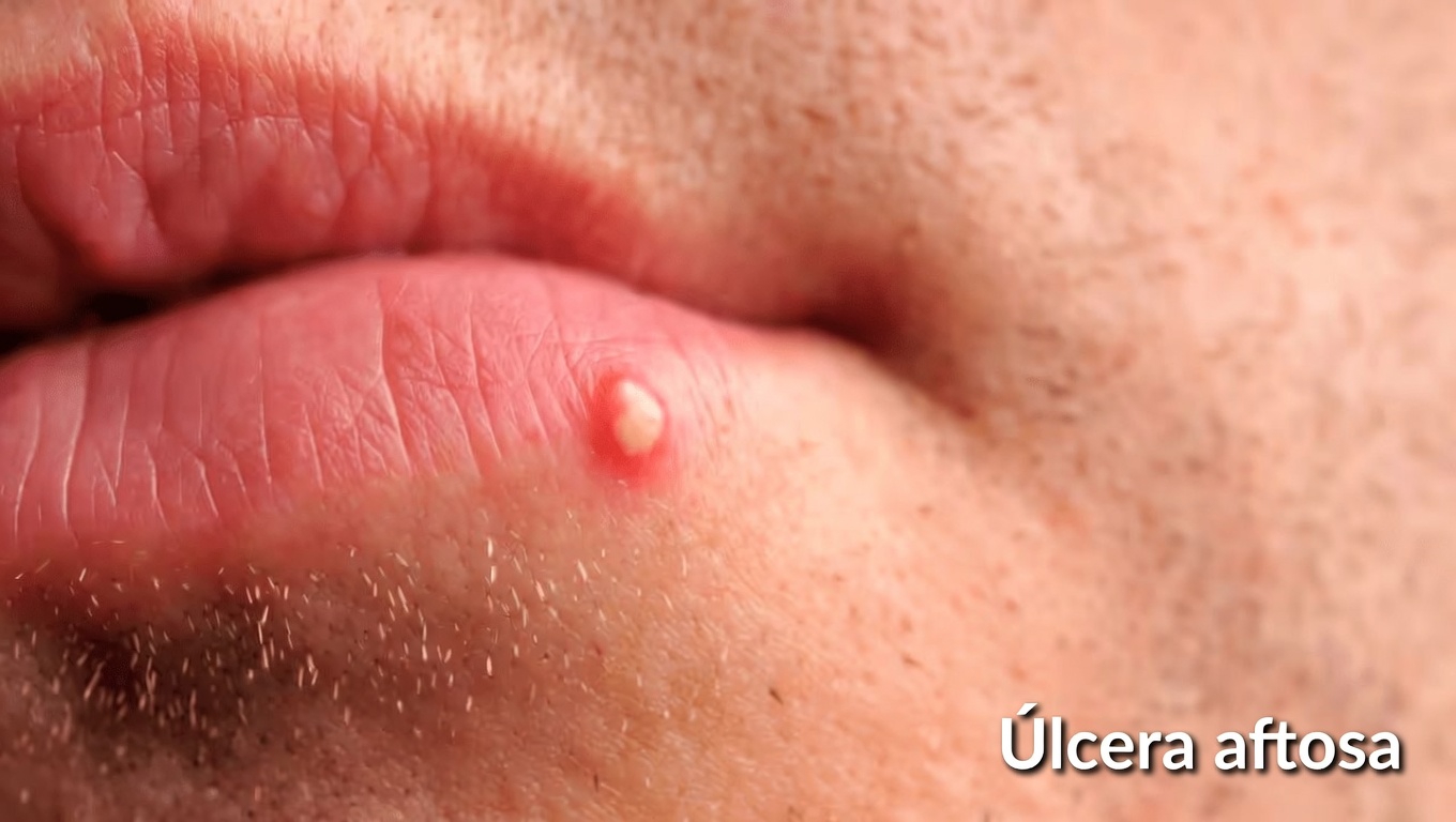 Aquelas bolinhas brancas irritantes nos lábios ou lá embaixo? Aqui está a VERDADEIRA história