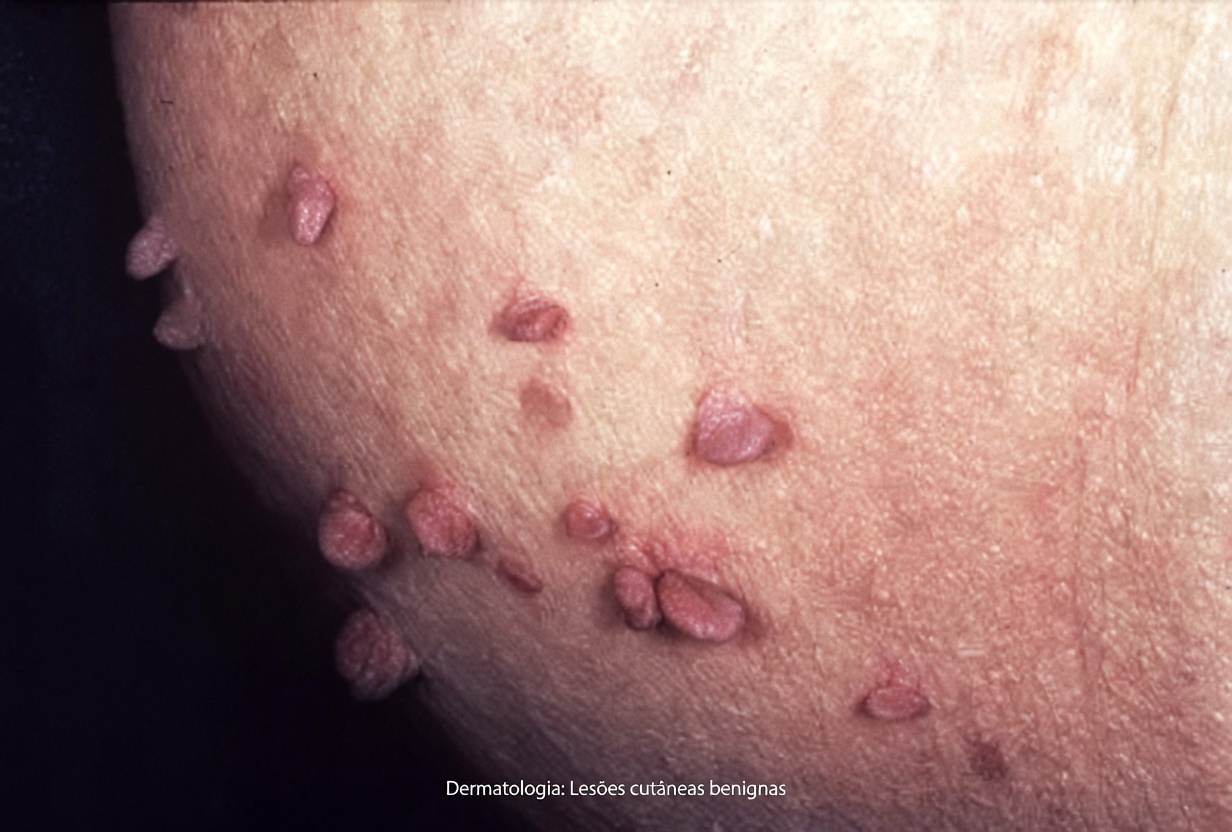 11 sinais de diabetes que poucas pessoas conhecem e podem estar escondidos à vista de todos