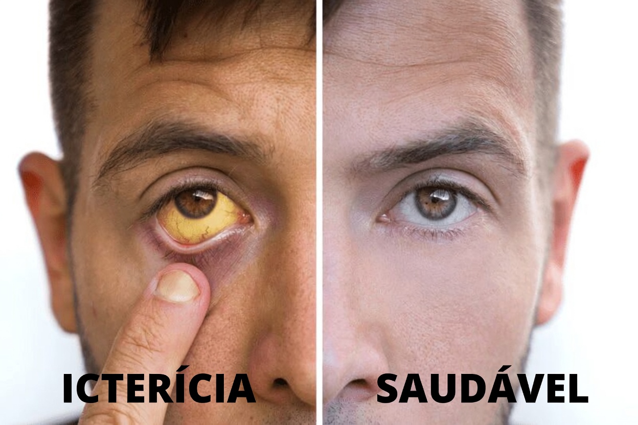 12 Sinais Silenciosos de Insuficiência Hepática que Você Precisa Identificar Cedo (Antes que Seja Tarde Demais!)