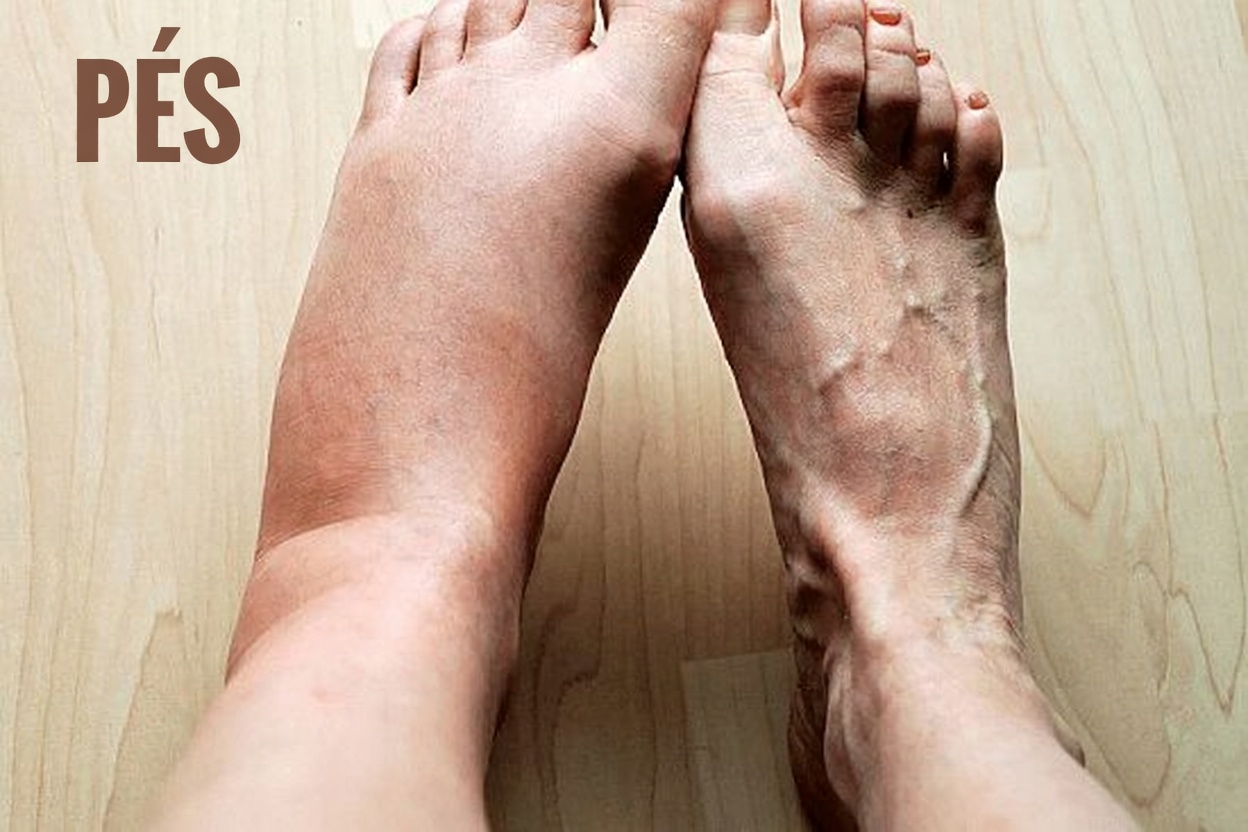 O que pernas inchadas podem revelar sobre a sua saúde – e por que isso importa