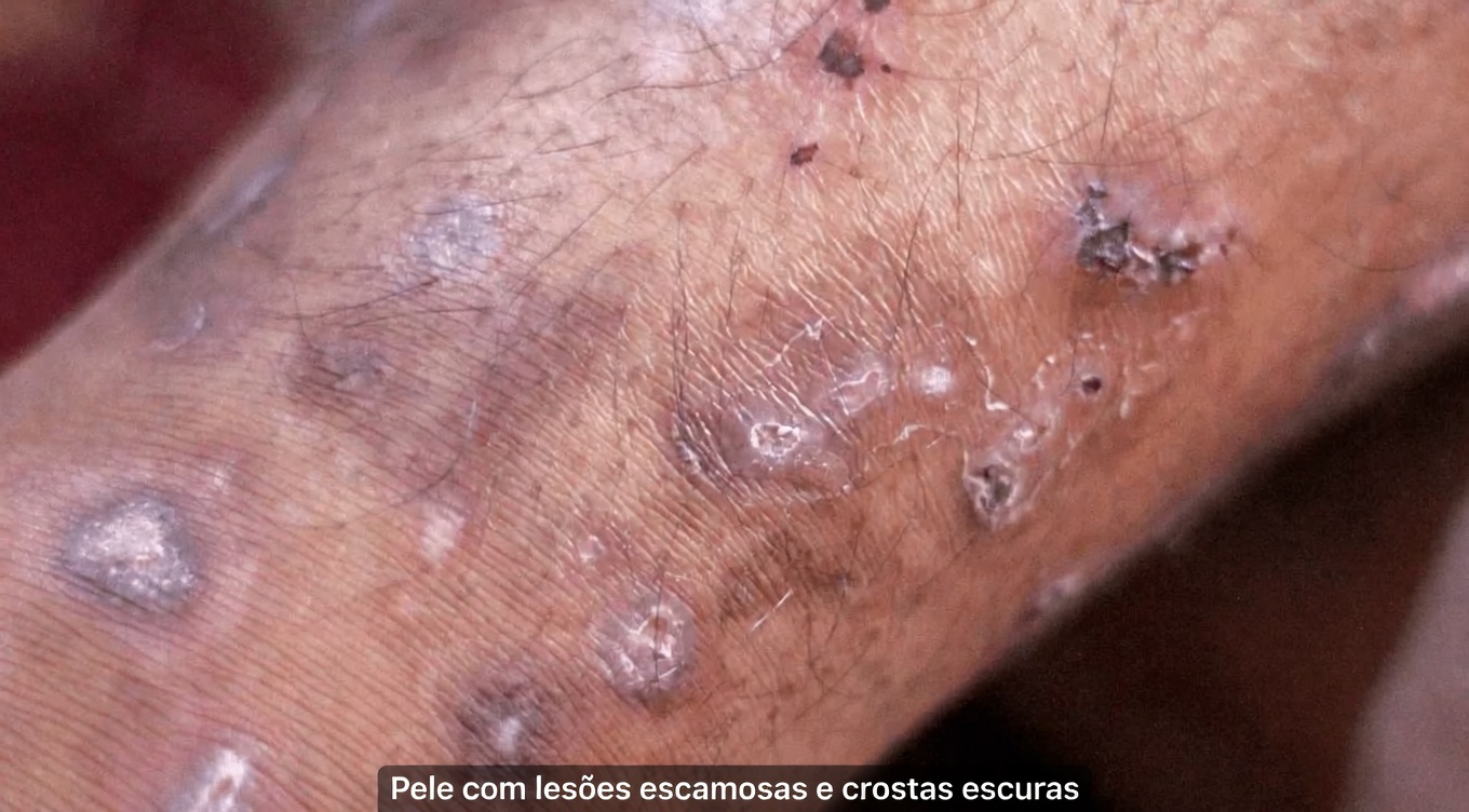 12 Sinais de Cirrose Hepática que Você Deve Conhecer para Aumentar sua Conscientização sobre a Saúde do Fígado