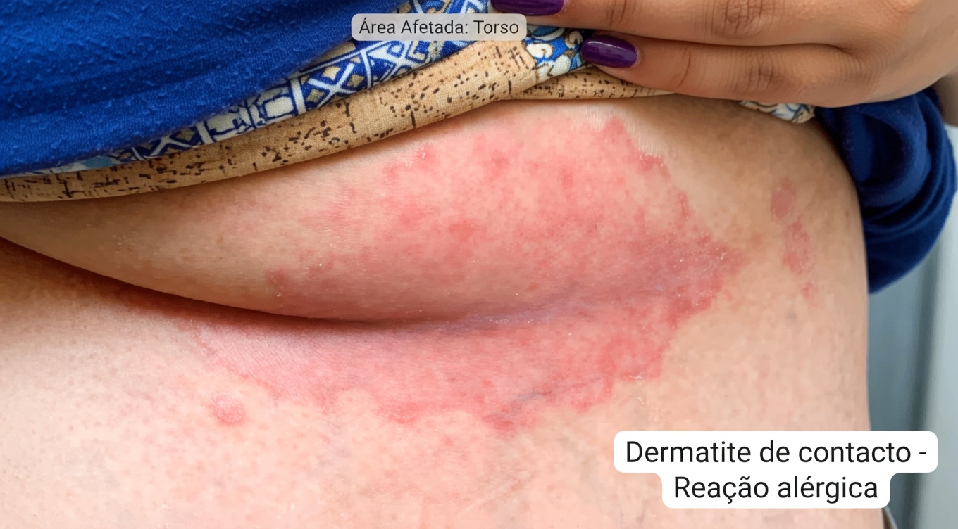 Causas Surpreendentes da Urticária Reveladas: O Que Pode Estar Desencadeando Essas Saliências Coceantes na Sua Pele