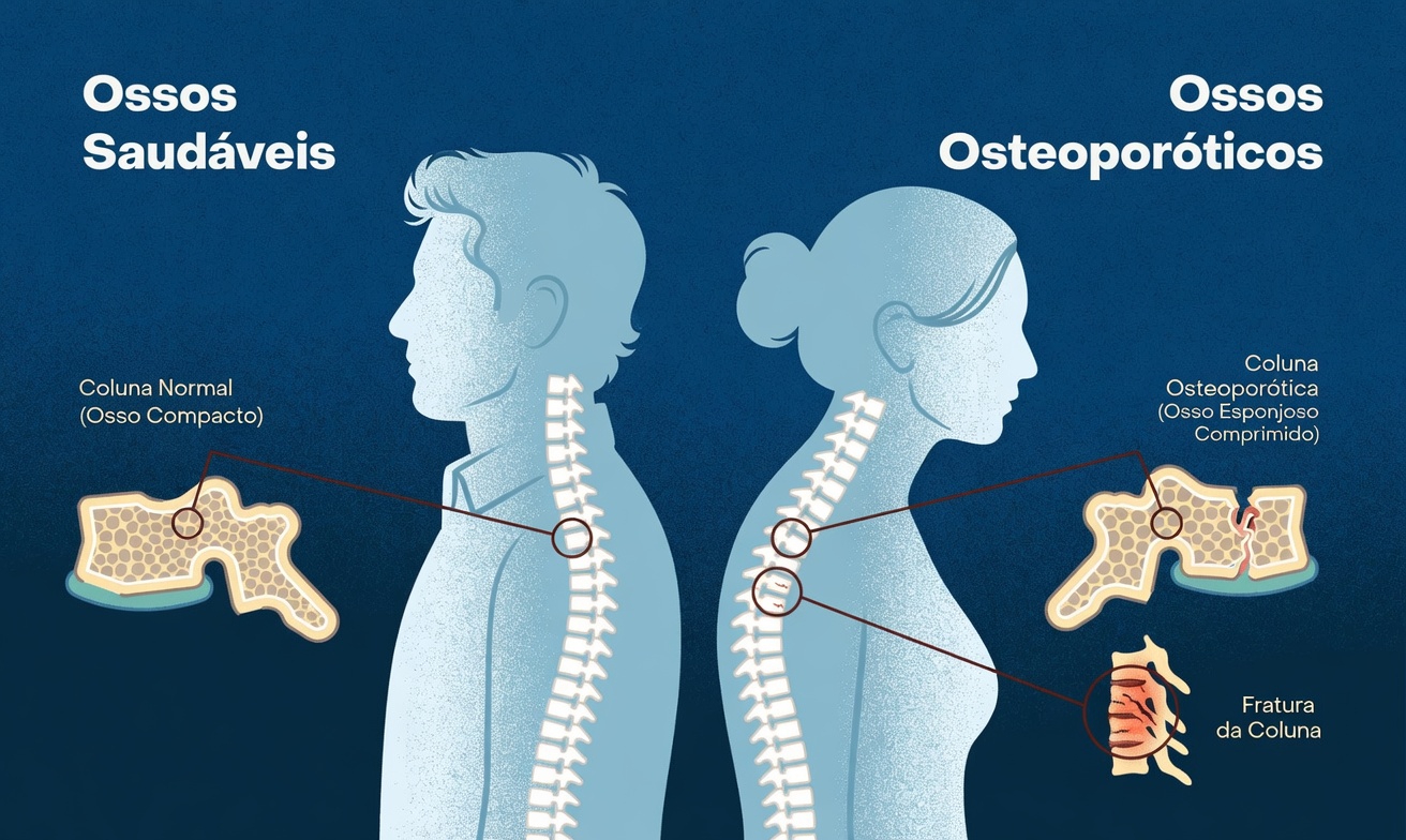 Coluna saudável vs. osteoporose: hábitos diários simples para fortalecer os ossos e melhorar a postura