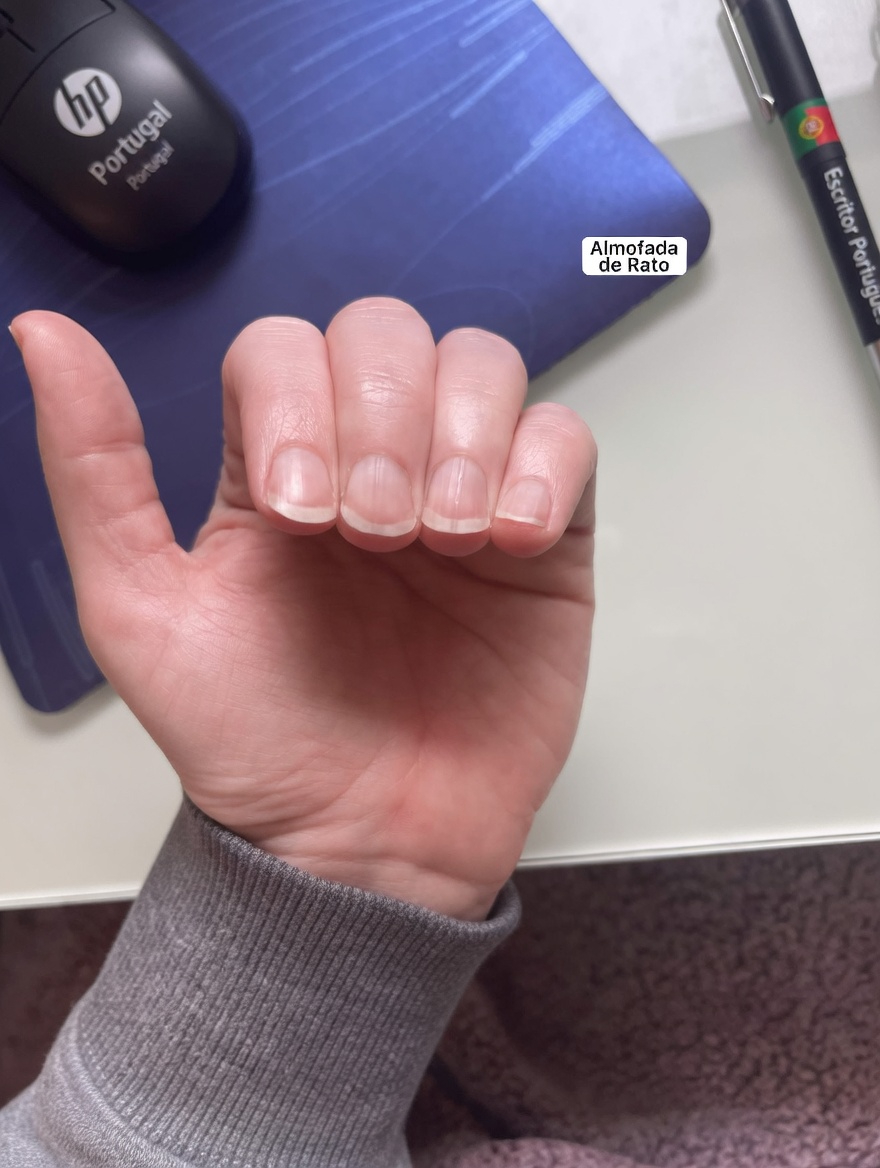 Por que aparecem linhas nas unhas? O que elas podem revelar sobre a sua saúde