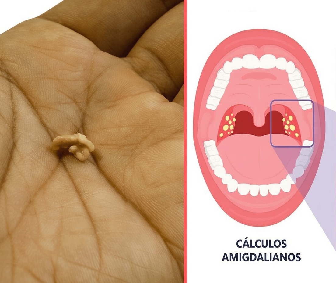 Entendendo os cáseos amigdalianos: eles poderiam ser o motivo oculto do seu mau hálito persistente?