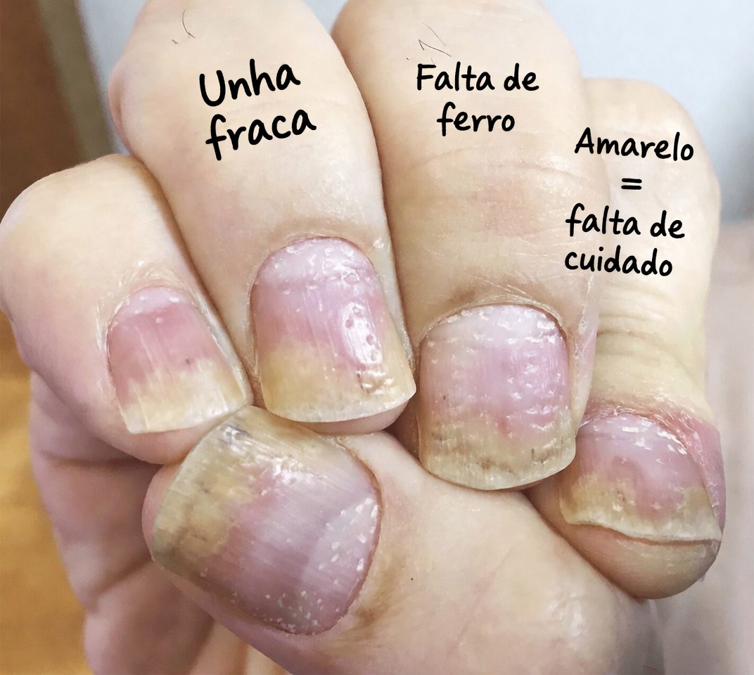 Descubra por que o cravo-da-índia está ganhando atenção por apoiar a saúde das unhas: receitas simples, benefícios e hábitos diários explicados