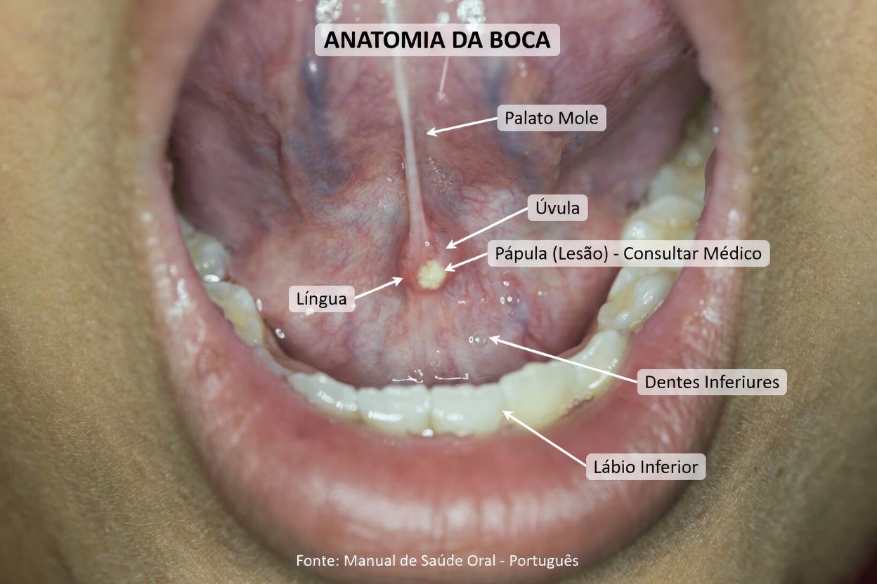 Por que essas pedras brancas que cheiram muito mal se formam na sua boca? O que faz com que elas apareçam