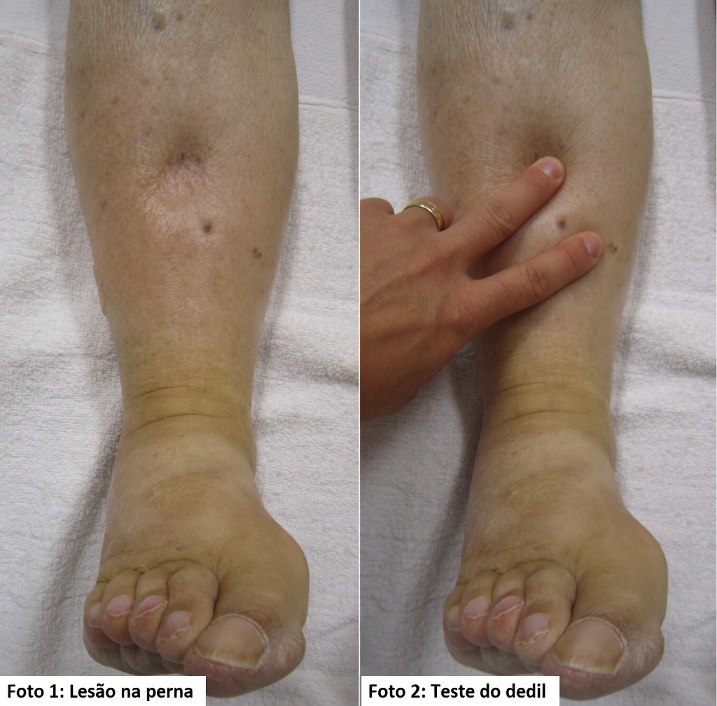 Descubra 12 efeitos colaterais da amlodipina que você deve conhecer e dicas práticas para lidar com eles