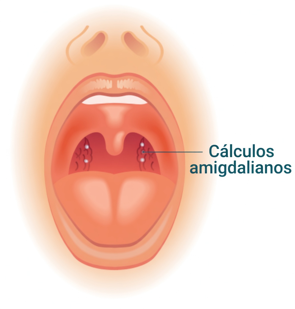 O Que É Aquele Caroço Estranho Que Você Tossiu Depois de Espirrar? Explorando os Cálculos Amigdalianos e o Que Eles Significam