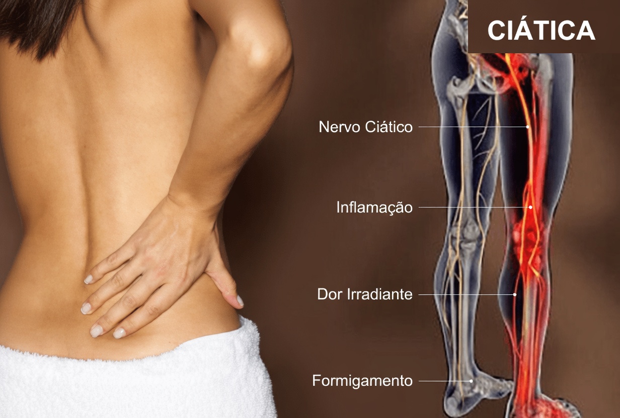 Um Guia Completo sobre a Ciática: Entendendo as Causas, Identificando os Sintomas e Explorando Hábitos para Ajudar a Controlar o Desconforto Nervoso