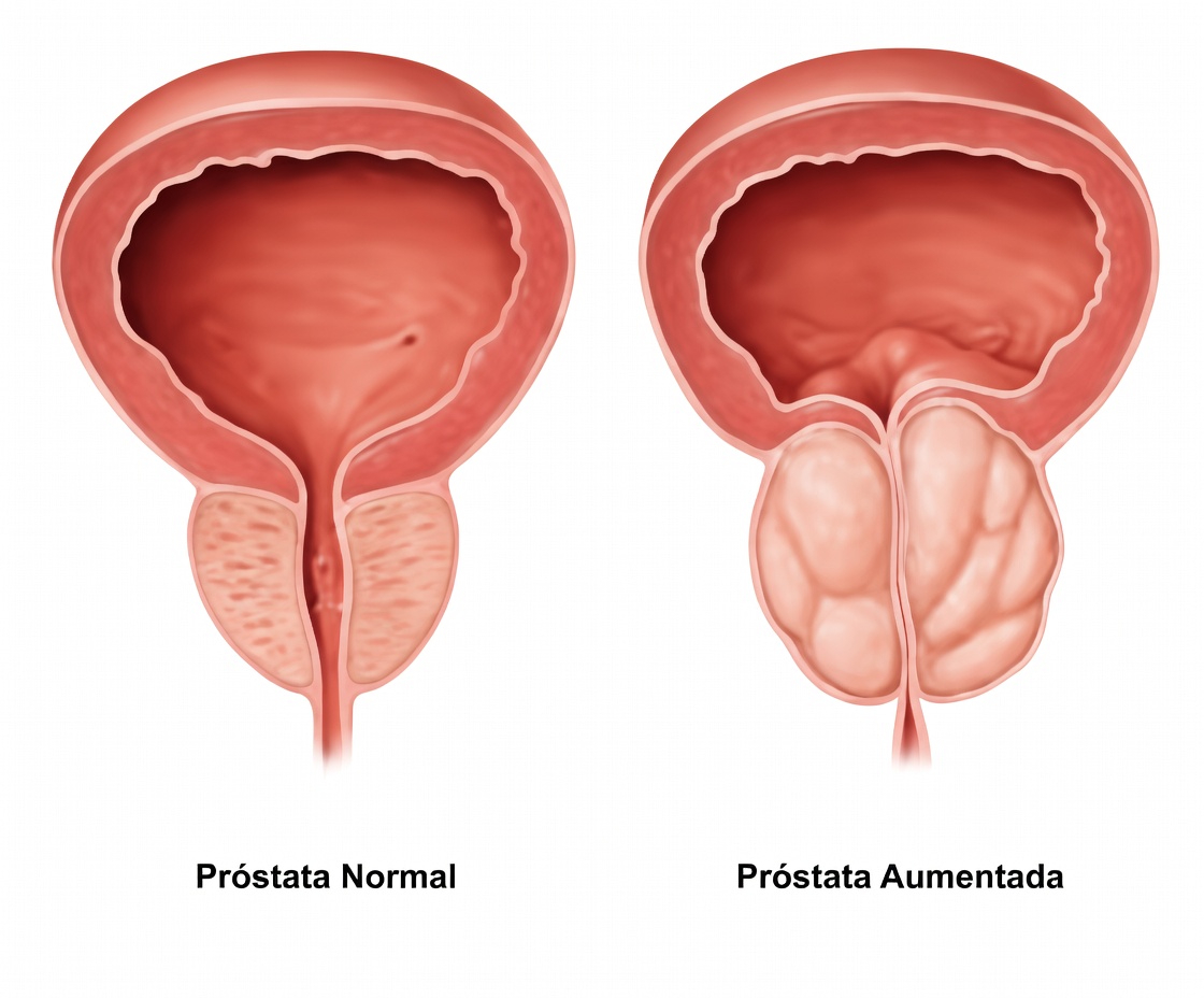 8 alimentos do dia a dia que podem aumentar as preocupações com a próstata (limitá-los pode ajudar a melhorar a saúde)