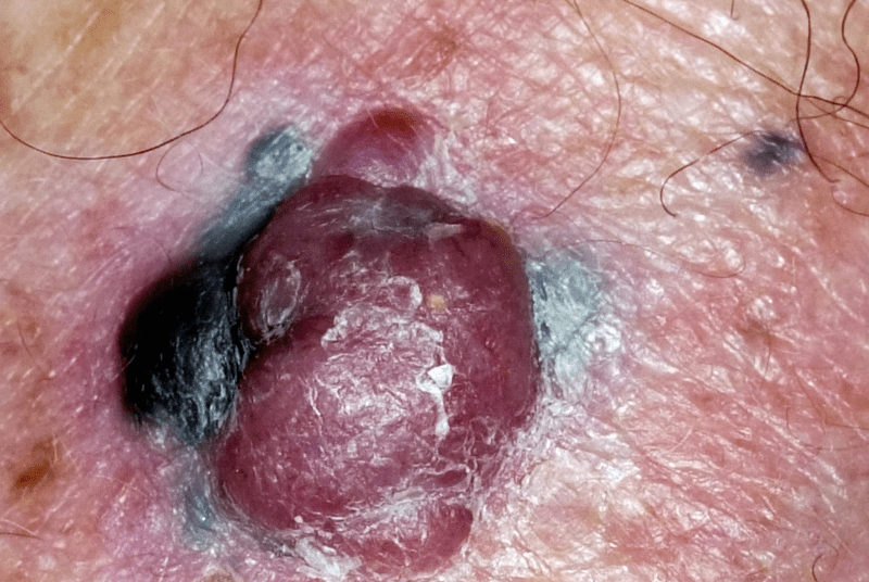 Os 14 sinais de alerta de câncer que você nunca deve ignorar – a detecção precoce pode salvar sua vida