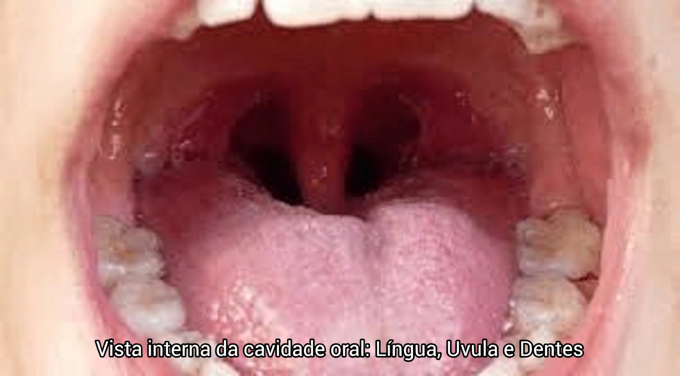 O Que São Aquelas Pedras Brancas na Sua Garganta que Causam Mau Hálito e Desconforto?