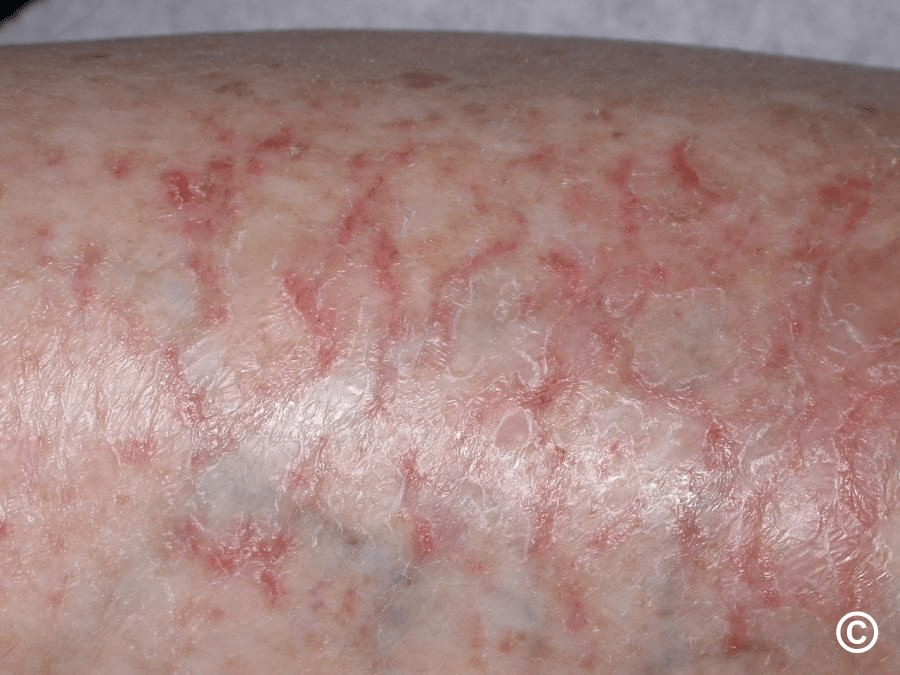 Descubra o que seus pés revelam sobre a saúde do seu fígado: 12 sinais comuns aos quais prestar atenção