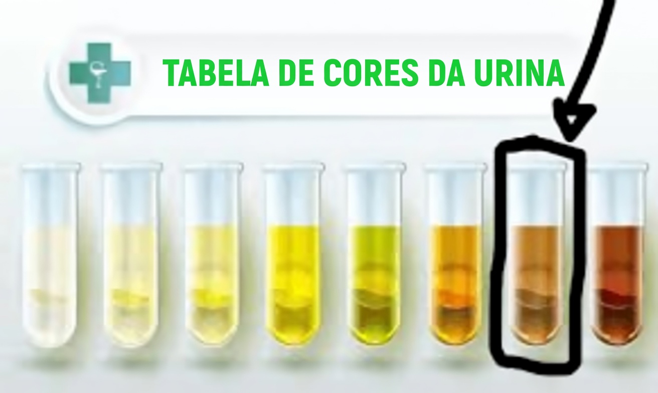 12 sinais de cirrose hepática que você deve conhecer e maneiras práticas de proteger seu fígado