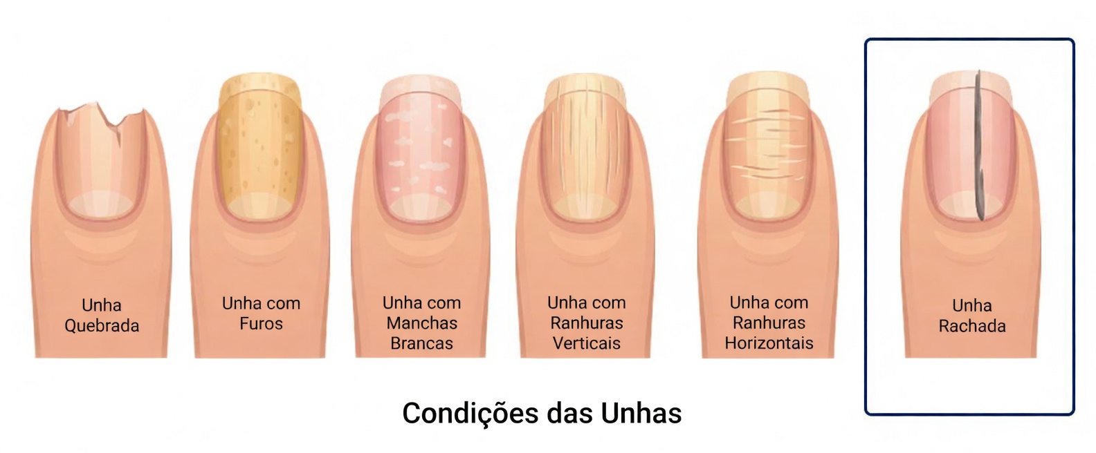Linhas nas unhas: o que podem significar e hábitos diários simples para ter unhas mais saudáveis