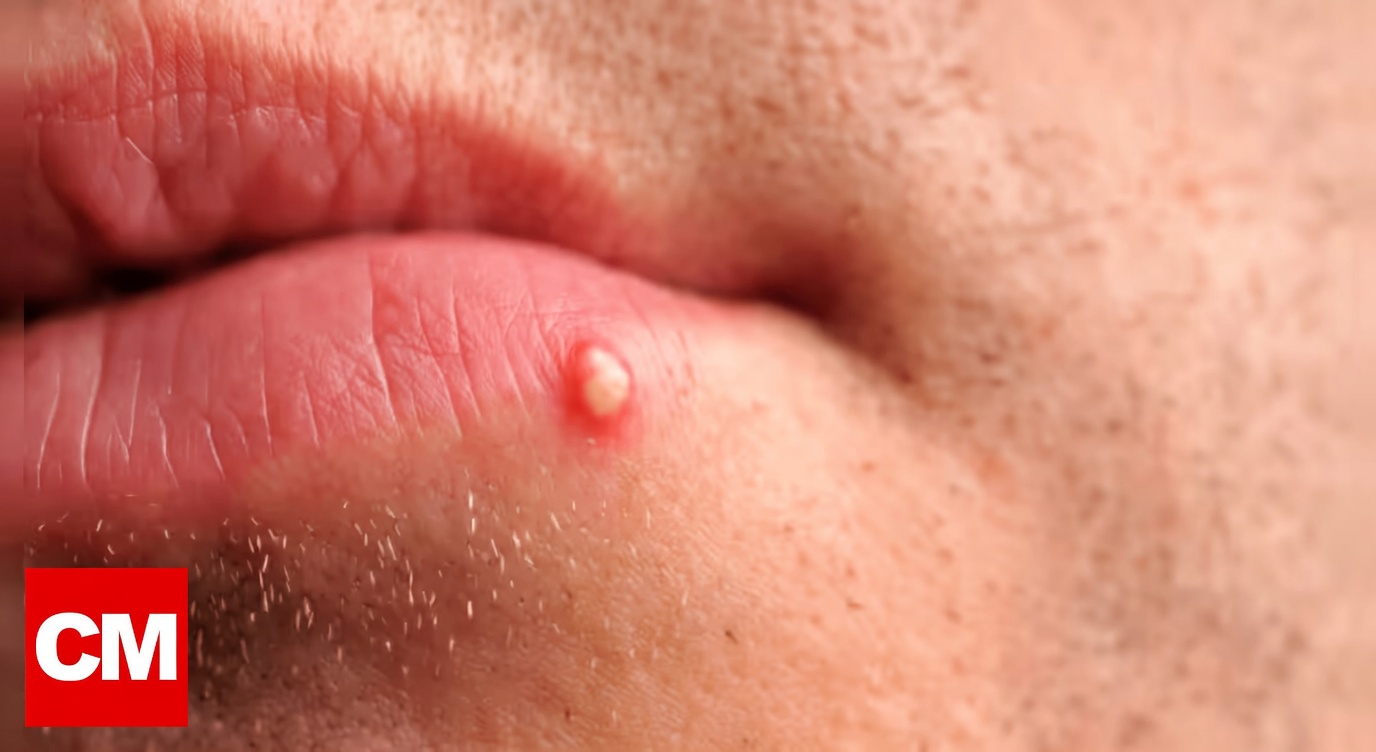 Por que você pode perceber pequenas bolinhas brancas incomuns nos lábios ou nas partes íntimas e o que isso significa