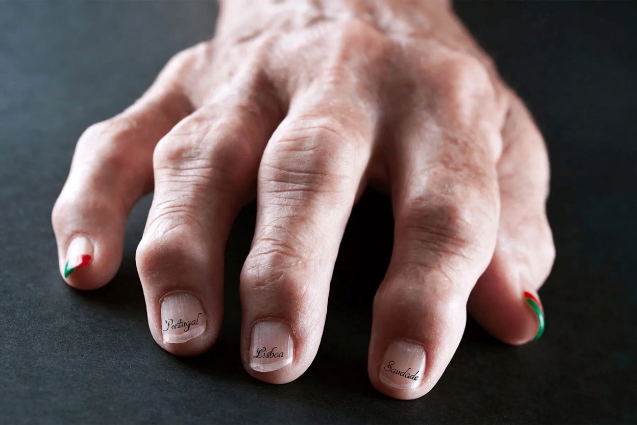 Quais são os novos avanços em tratamentos disponíveis para pacientes com artrite reumatoide que buscam esperança de dias melhores