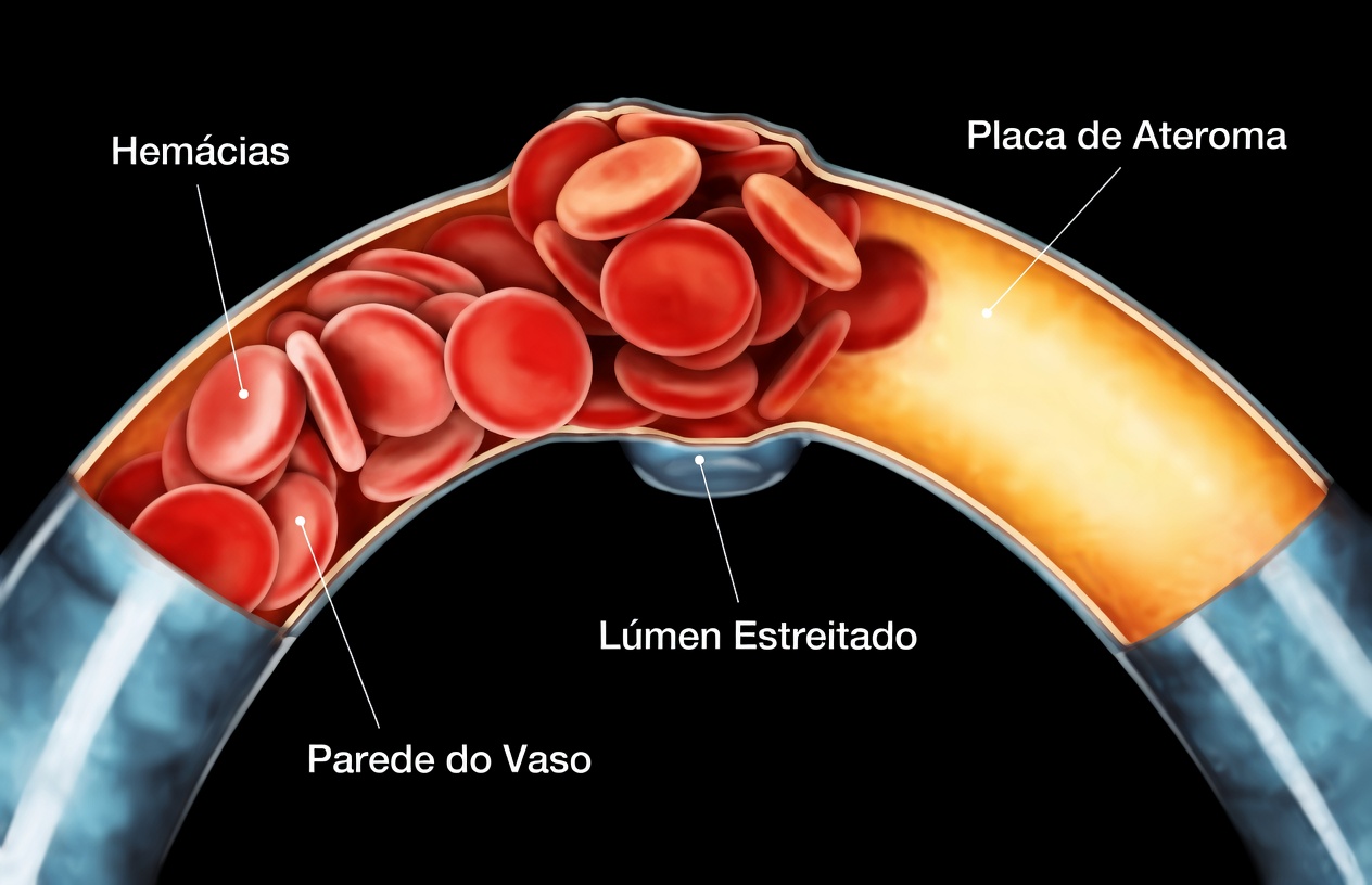Médicos alertam: 10 sinais silenciosos de que as artérias das suas pernas estão entupidas