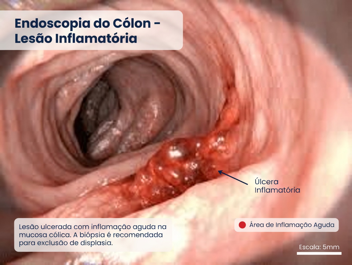 7 Sinais de Alerta Sutis do Câncer de Cólon que Você Nunca Deve Ignorar e Como a Consciência Pode te Empoderar