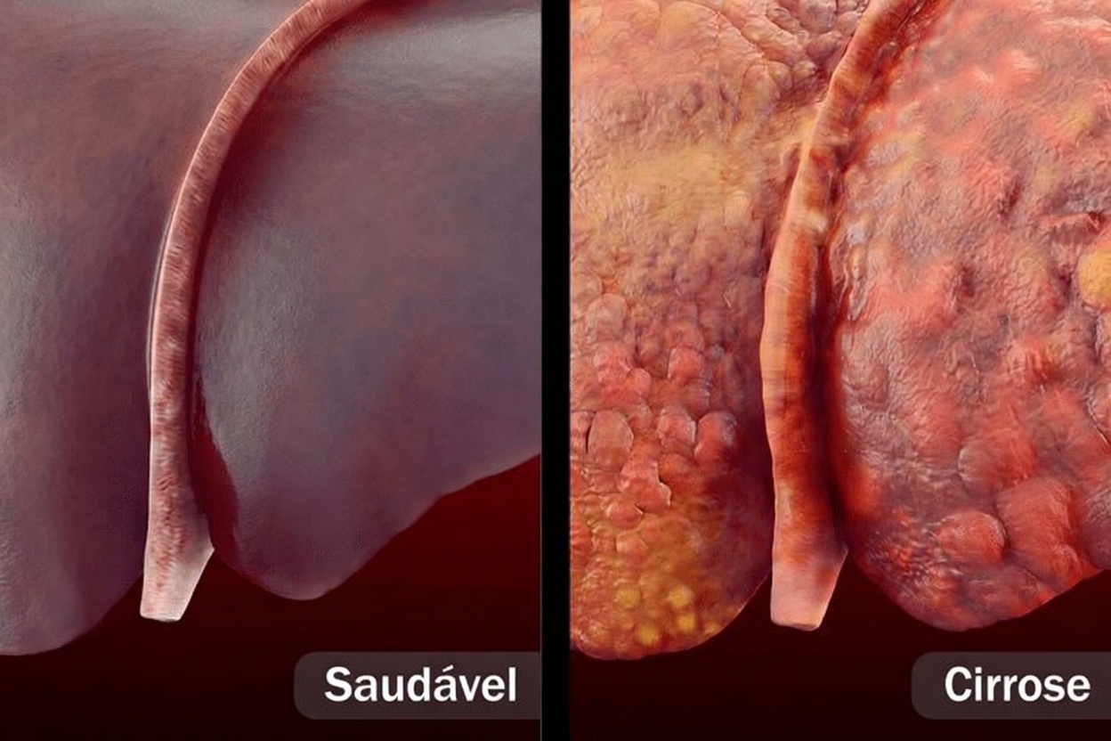 A Ameaça Silenciosa Escondida no Seu Fígado: 8 Sinais de Alerta da Doença do Fígado Gorduroso que Você Precisa Reconhecer