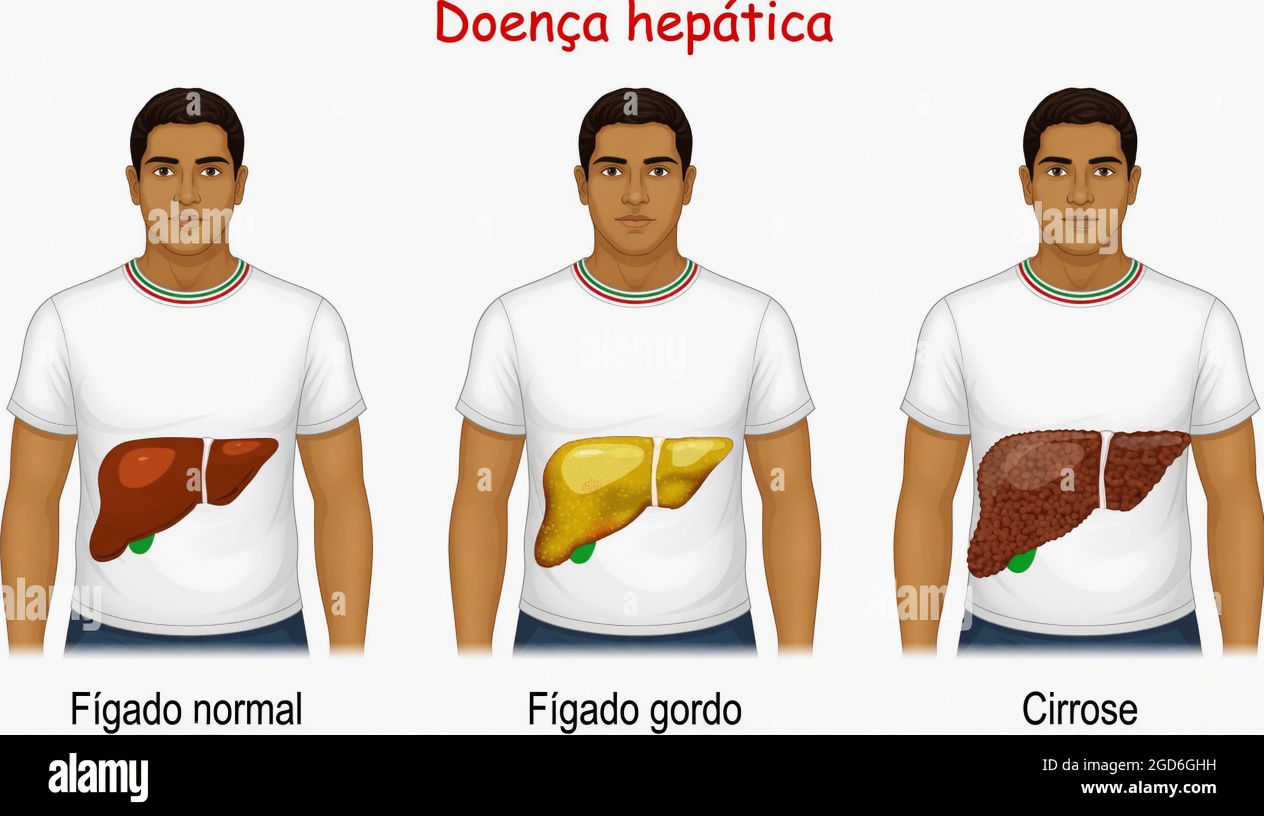 A Ameaça Silenciosa Escondida no Seu Fígado: 8 Sinais de Alerta da Doença do Fígado Gorduroso que Você Precisa Reconhecer