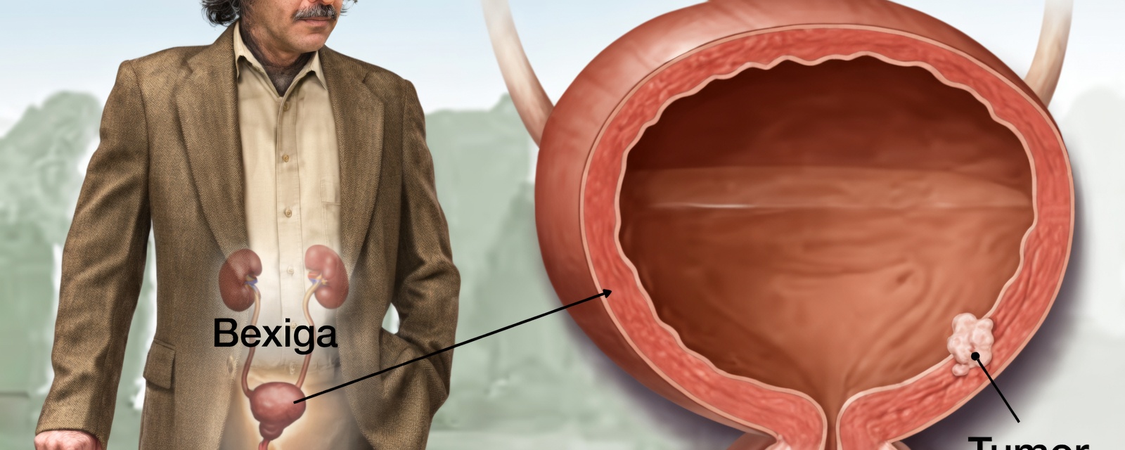 O Câncer de Bexiga é um Perigo Oculto: 10 Sinais de Alerta que Você Não Deve Ignorar