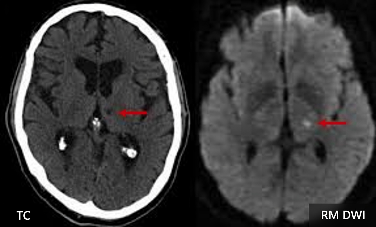 7 Sinais de Alerta de AVC Lacunar em Pessoas Acima de 60 Anos que Todos Ignoram (Especialmente o nº 4)