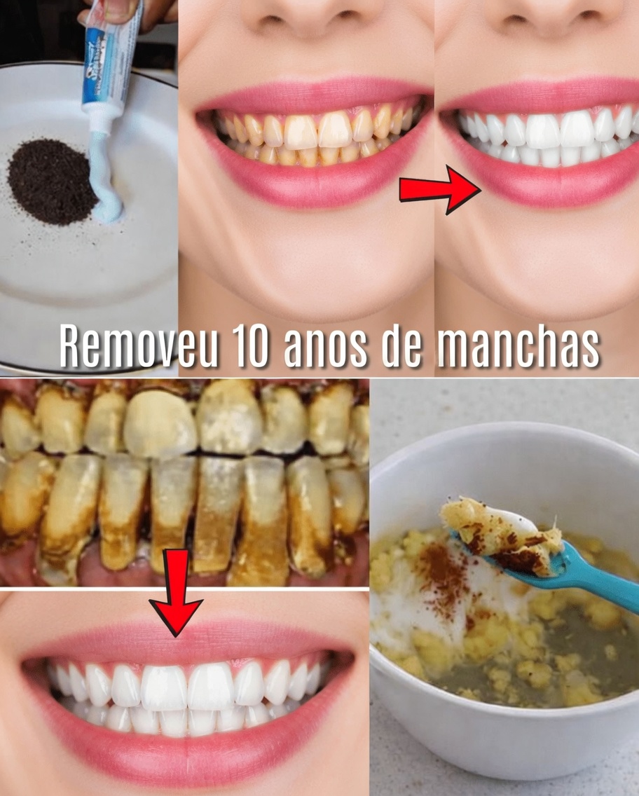 Em Apenas 2 Minutos, Remova 10 Anos de Manchas nos Dentes – O Clareador Natural que Realmente Funciona