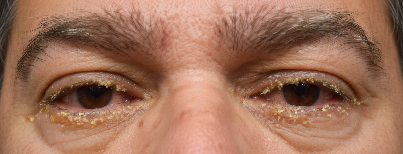 O olho do seu filho pequeno está grudado com uma gosma amarela? Maneiras seguras de limpá-lo em casa