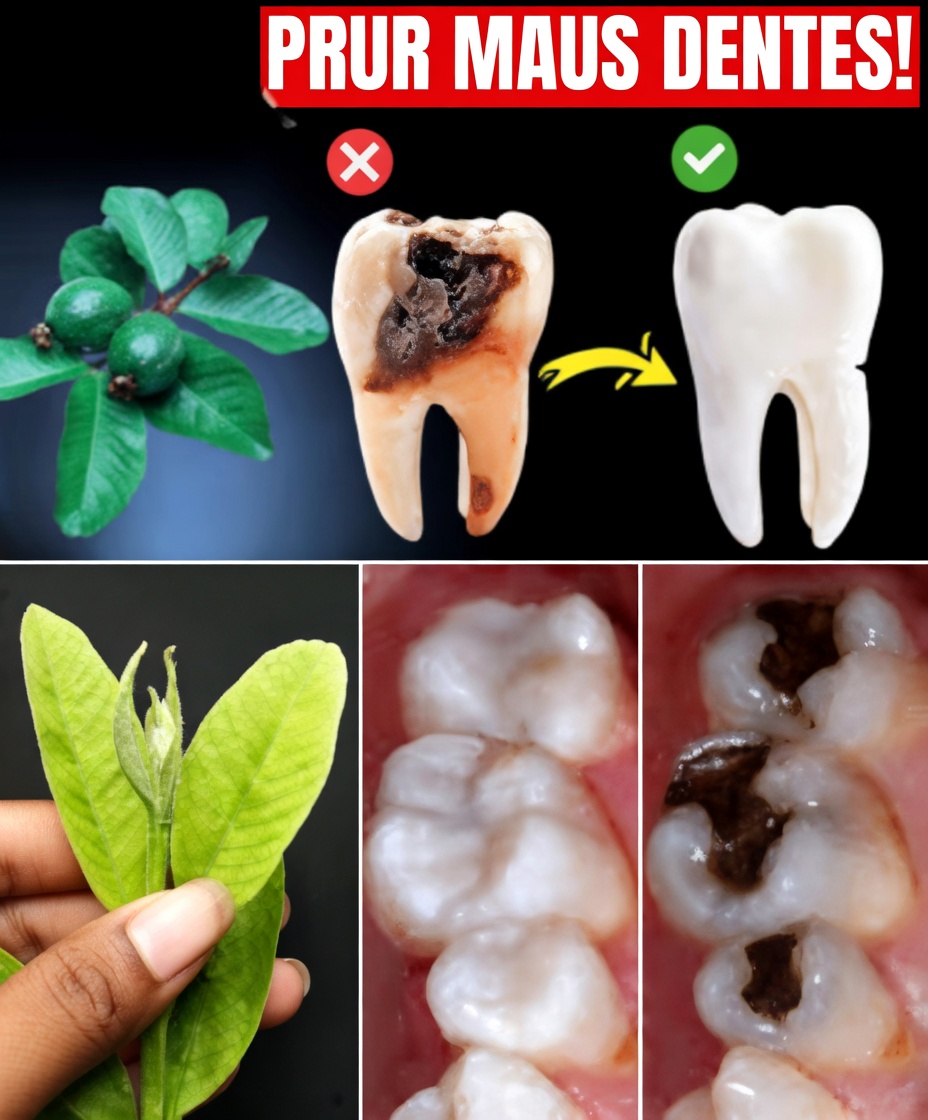 3 Principais Formas Naturais de Apoiar a Saúde dos Dentes Usando Folhas de Goiabeira – Simples e Econômico!