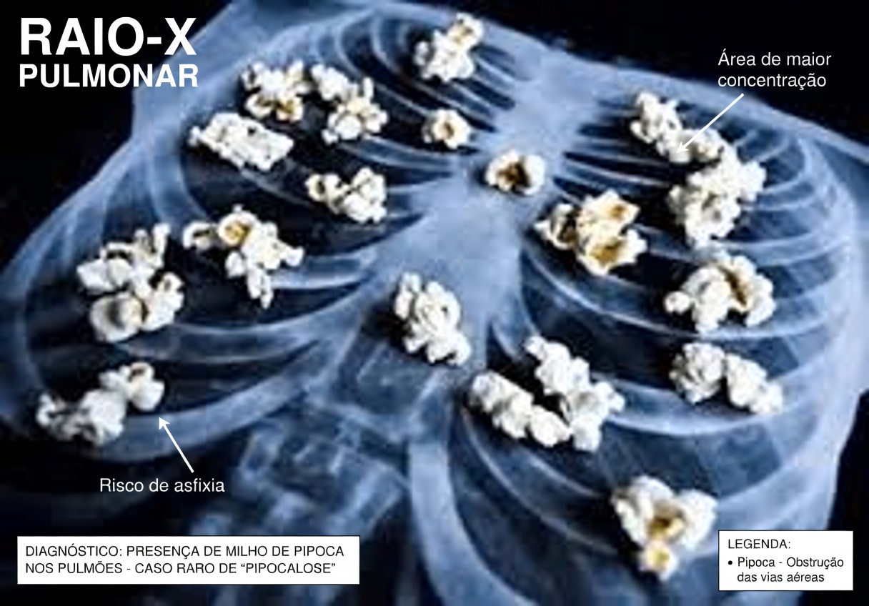 Alerta Urgente: “Pulmão de Pipoca” Ligado ao Vaping Causa Danos Duradouros, Alertam Especialistas