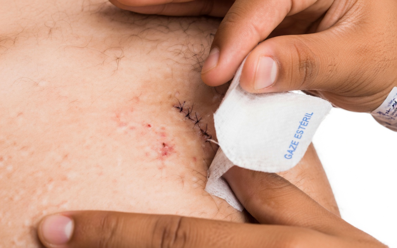 Remova as acrocórdons durante a noite com Vaselina