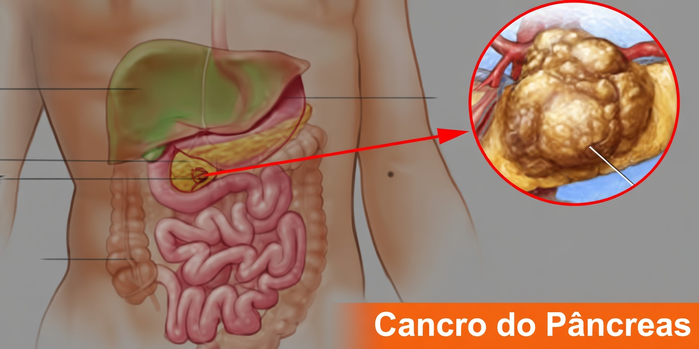 10 Sinais Sutis de Alerta de Câncer de Pâncreas que Seu Corpo Está Sussurrando Agora Mesmo