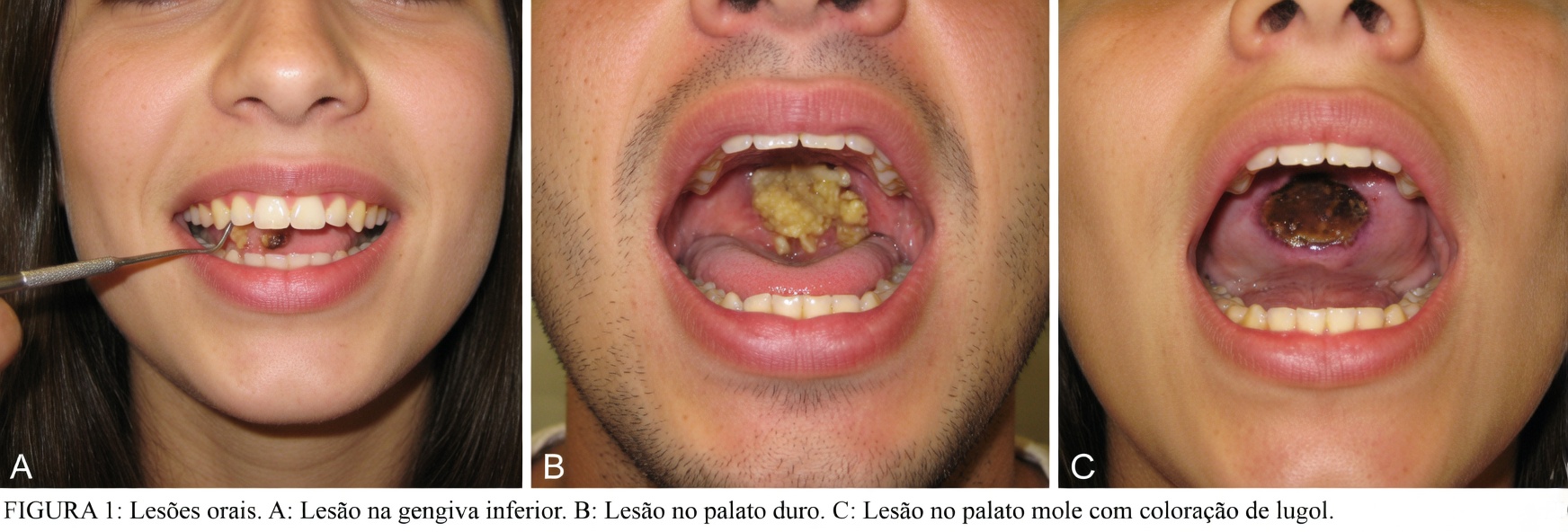 Mulher sofre infecção fúngica nasal ligada a um hábito cotidiano
