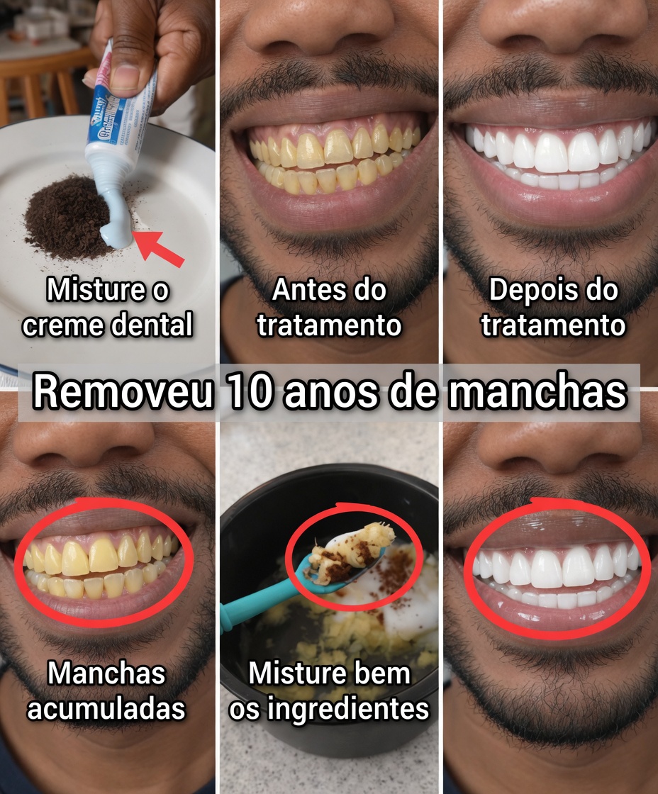 Em Apenas 2 Minutos, Remova 10 Anos de Manchas nos Dentes – O Clareador Natural que Realmente Funciona