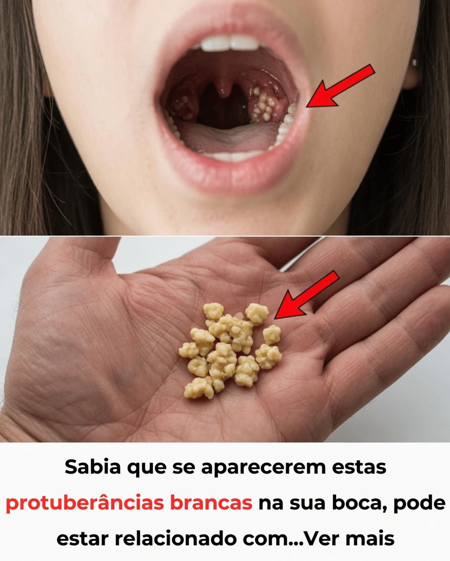 Cálculos Amigdalianos: Descubra o que são, como aparecem e como se livrar deles para sempre