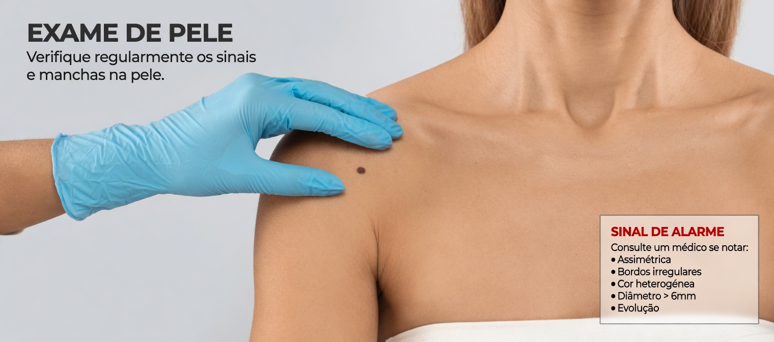 Melhores Remédios Caseiros Naturais para Ajudar com Segurança na Remoção de Acrocórdons em Casa (O Que Realmente Funciona e com O Que Você Deve Ter Cuidado)