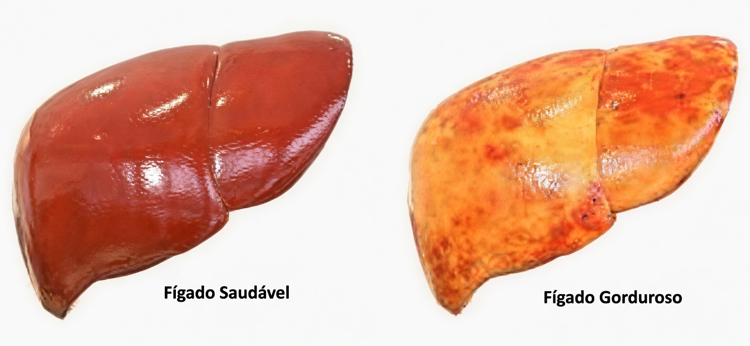 14 Possíveis Sinais de Alerta de Fígado Gorduroso Que Você Pode Notar: Além de Alimentos do Dia a Dia Que Podem Apoiar a Saúde do Fígado