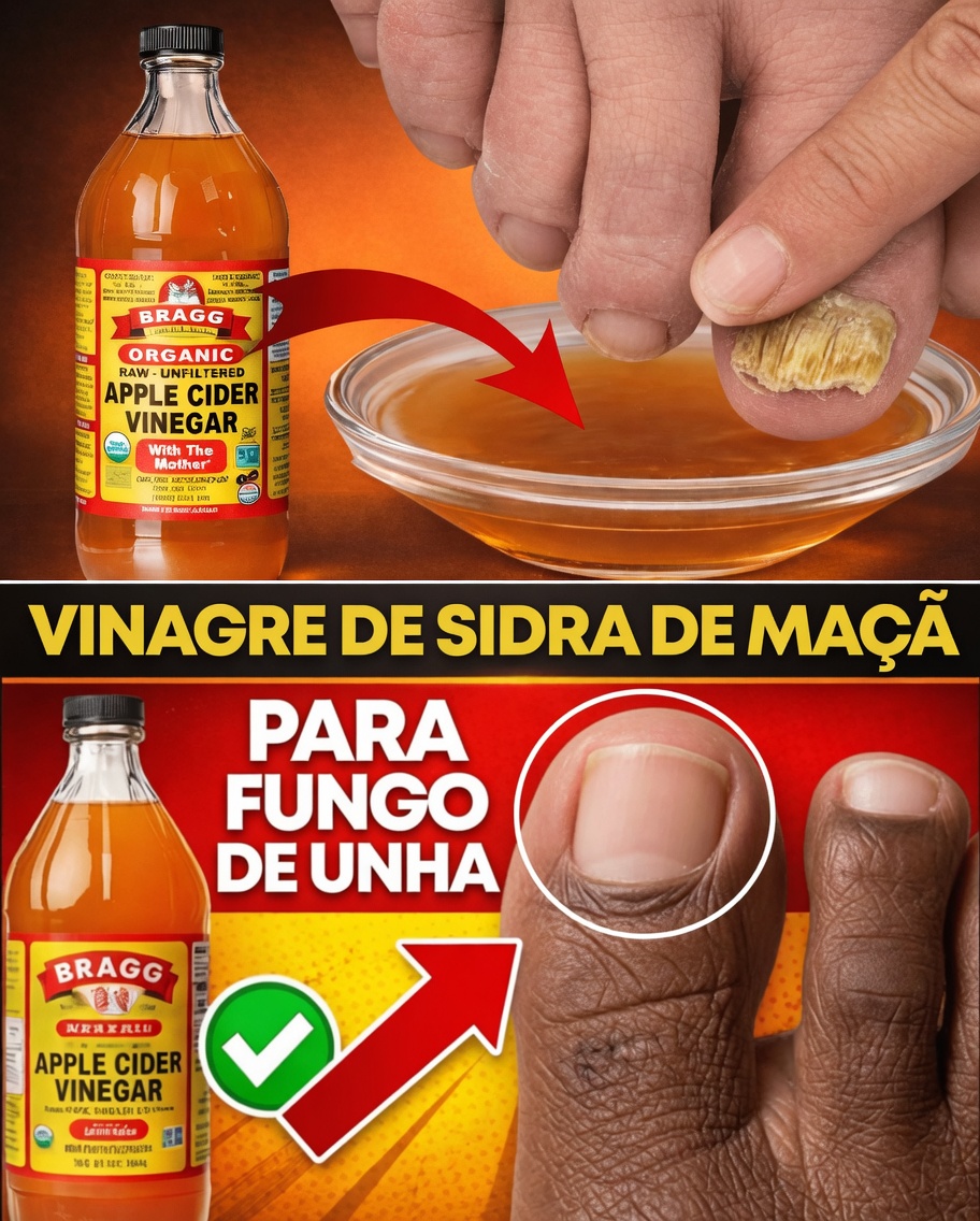 Tratamento de Fungos na Unha do Pé com Vinagre de Maçã: Uma Cura Rápida e Barata