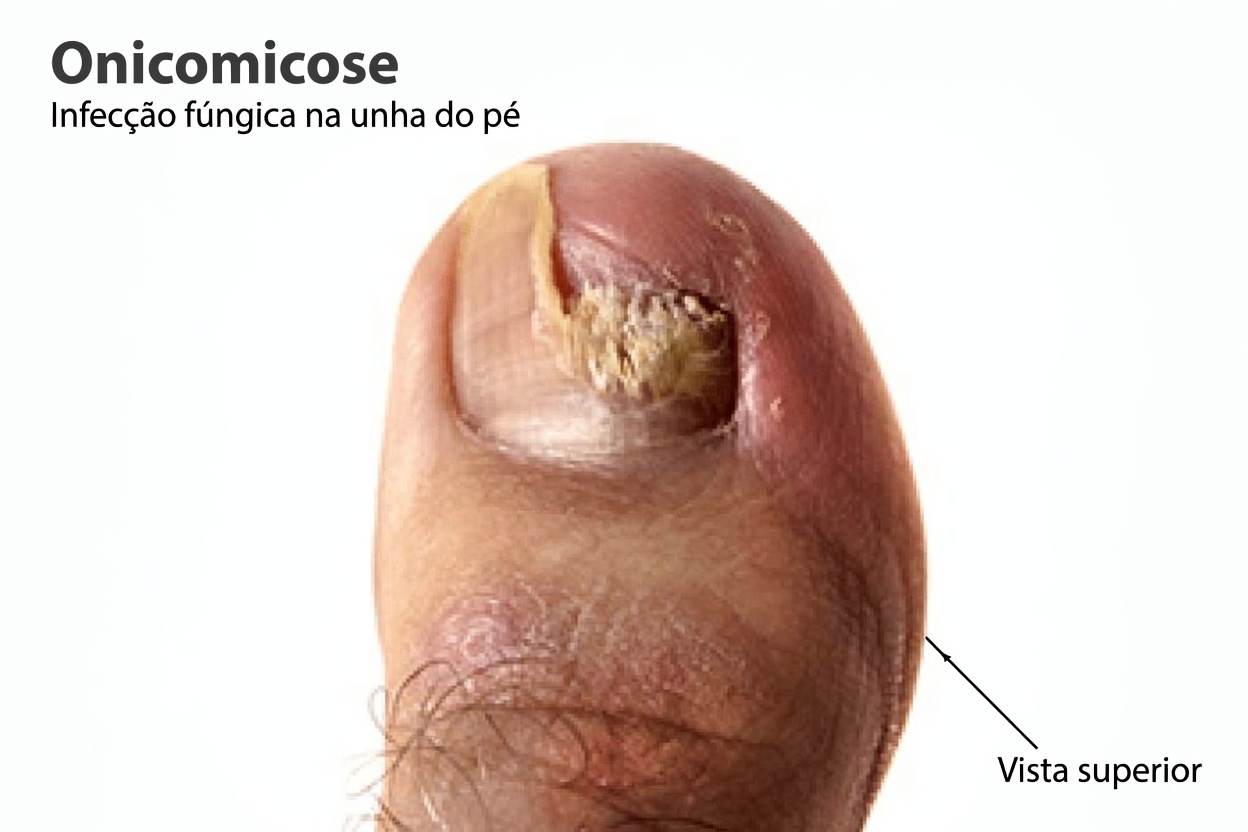 Tratamento de Fungos na Unha do Pé com Vinagre de Maçã: Uma Cura Rápida e Barata